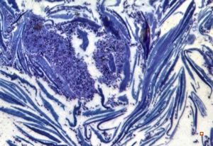 M,57y. | dermatomycosis - semithin section